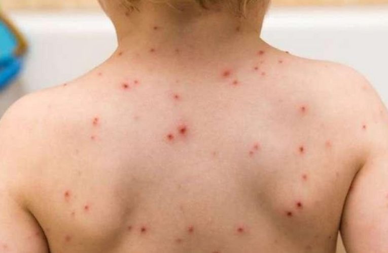 Azərbaycanda 1 yaşlı uşaq qızılcadan öldü