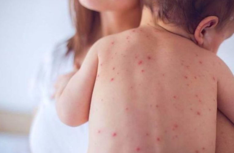 Azərbaycanda 10 nəfər qızılcaya yoluxub